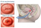 Bệnh viêm cổ tử cung: Nguy hiểm tiềm ẩn