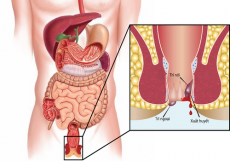 Bệnh trĩ: Chẩn đoán nguyên nhân, triệu chứng và cách điều trị