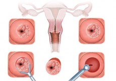 Bệnh viêm lộ tuyến cổ tử cung: Nguyên nhân và cách chữa trị
