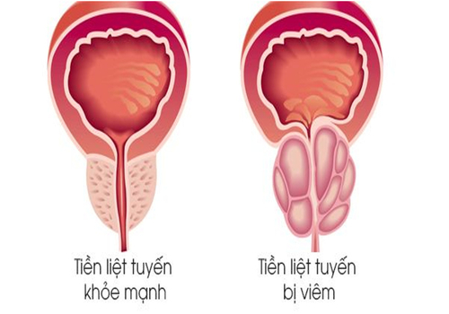 Viêm tuyến tiền liệt: Nguyên nhân, triệu chứng và cách chữa trị